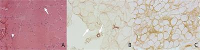 Characteristics of cardiac involvement in immune-mediated necrotizing myopathy